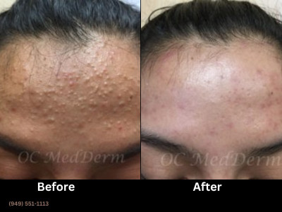 Pregnancy-Safe Acne Treatment in Irvine 