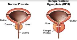 Most Effective Benign Prostate Hypertrophy Treatme