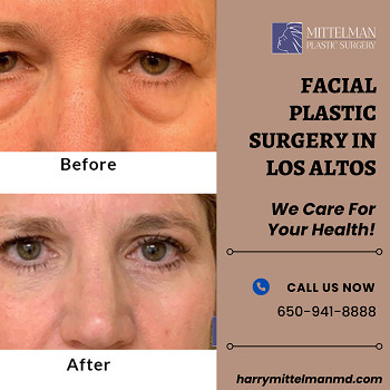 Facial Plastic Surgery in Los Altos CA