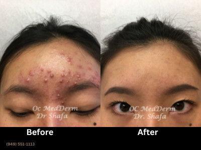 What is Accutane (Isotretinoin)? Acne Treatment 