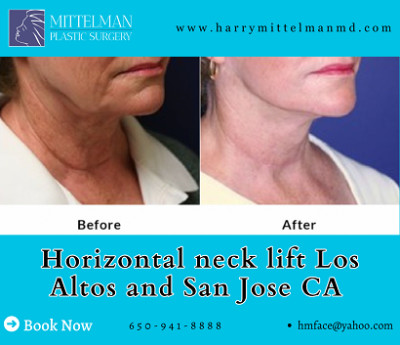 Horizontal neck lift Los Altos CA to tighten saggi