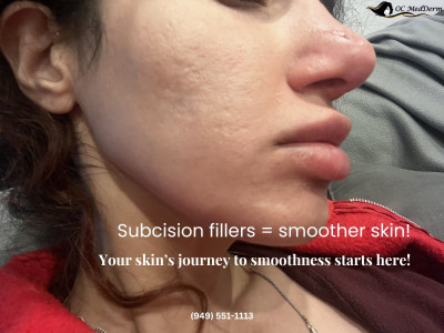 How Long is the Downtime for Subcision Fillers?