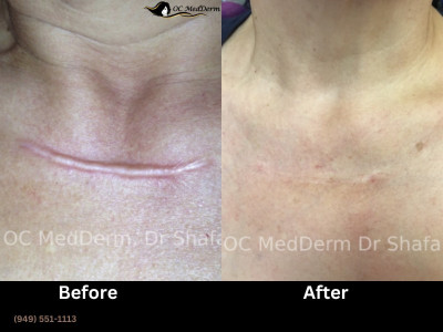 Keloid Removal treatment Irvine, California OC MedDerm Irvineskin.jpg